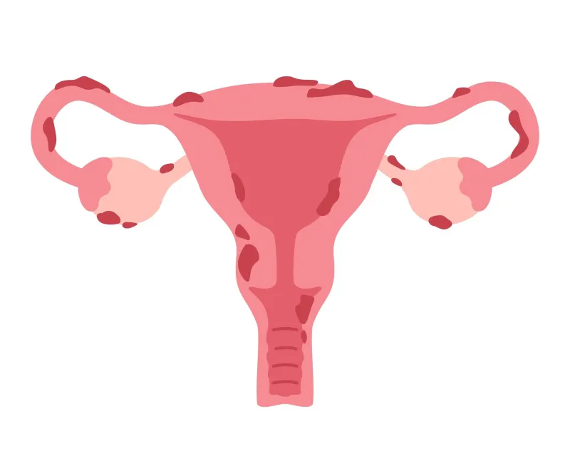 uterus,with,endometriosis,illustration,in,flat,style.