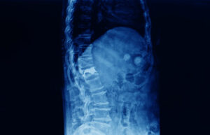 vertebroplastik